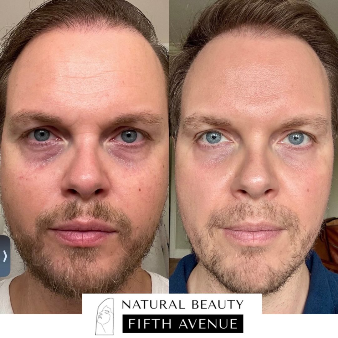 Before and after comparison of male patient showing reduced under-eye hollowing and puffiness following Rejuran Healing Essence treatment